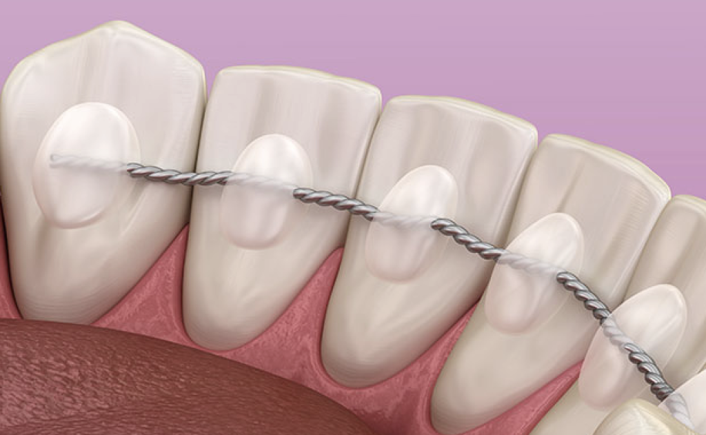 What Is a Permanent Retainer?