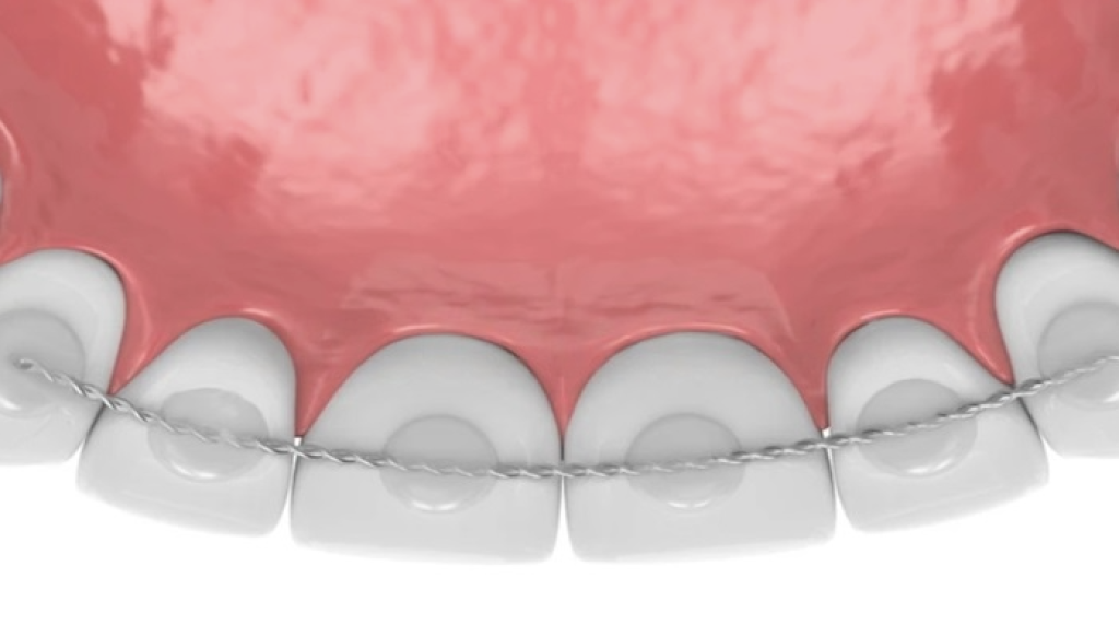 Permanent (Fixed) Retainers