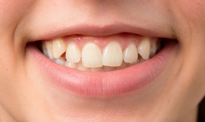 Crowded Teeth - Causes and Treatment Options-photo